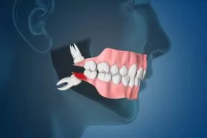 wisdom-teeth-Good-Samaritan-Dental-Implant-Institute